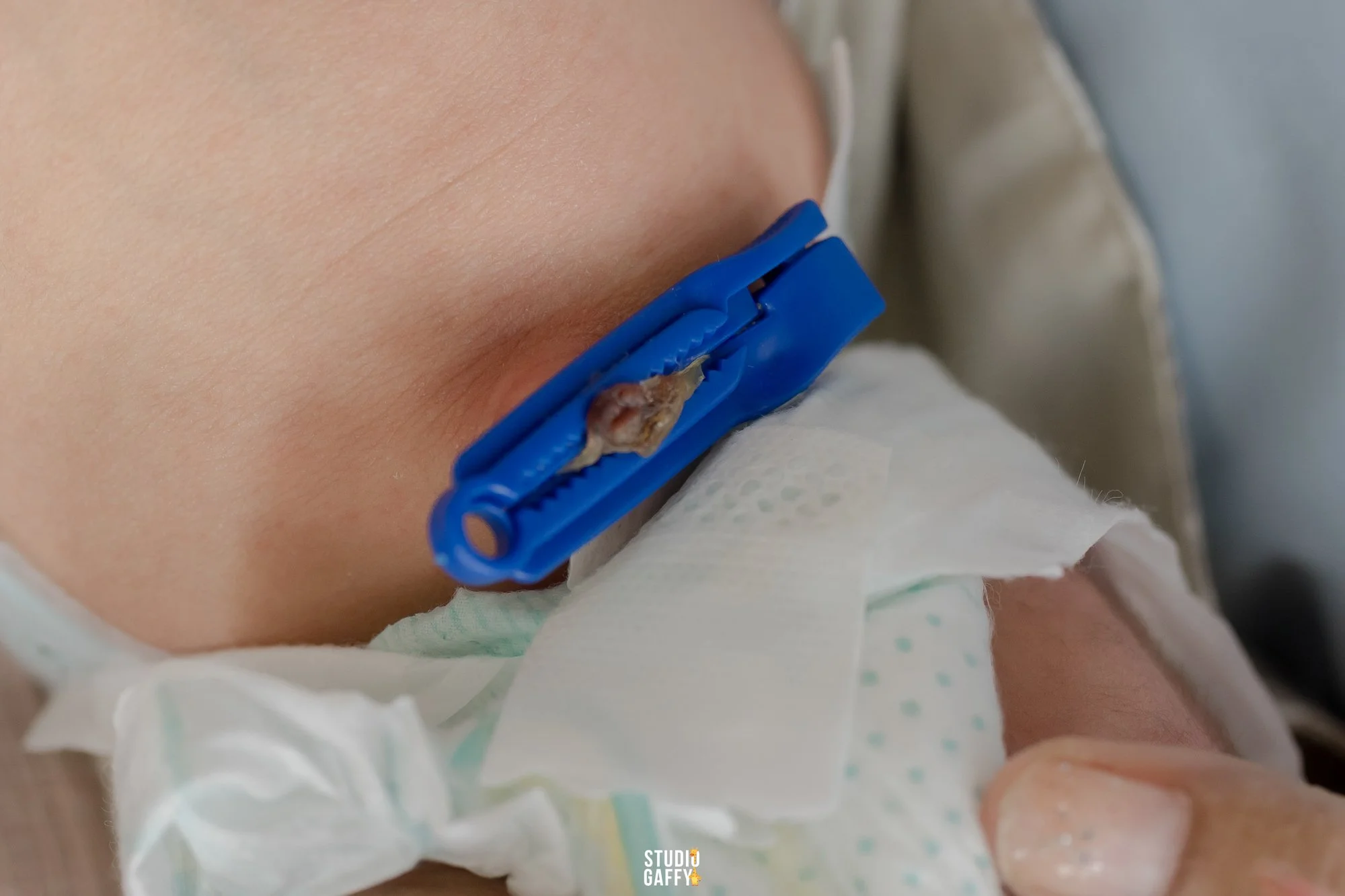 Close-up of a newborn baby's shoulder with an umbilical cord clamp attached to the cord near the navel. The baby is lying on a hospital bed, wrapped in a white cloth.