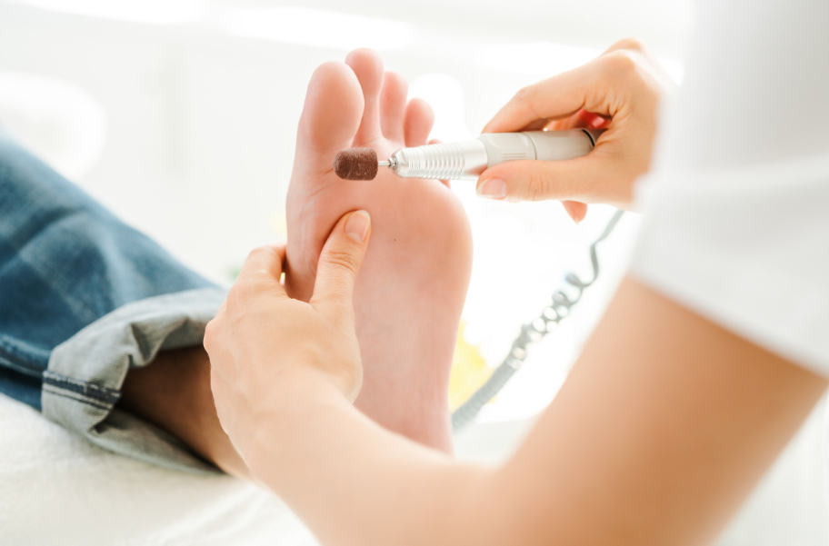 Stock image of podiatrist filing a callus from the bottom of a person's foot | Leicestershire