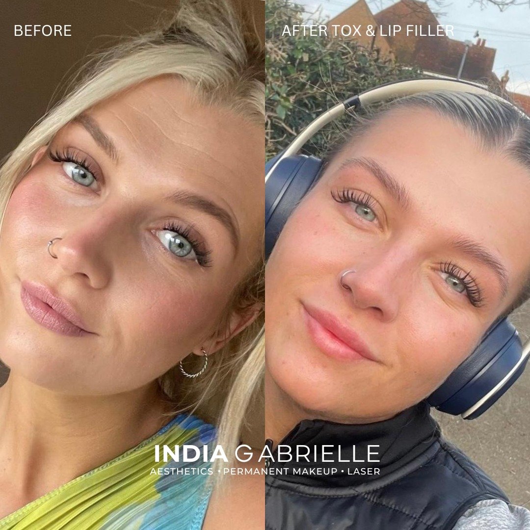 My STUNNING client 😍 This is before and after Wrinkle Relaxing Injections and a subtle 0.7ml of Lip Filler by moi - India Gabrielle 💋💉
 
There is a common misconception that aesthetics will lead to a 'frozen face' or 'duck lips' as you can see thi