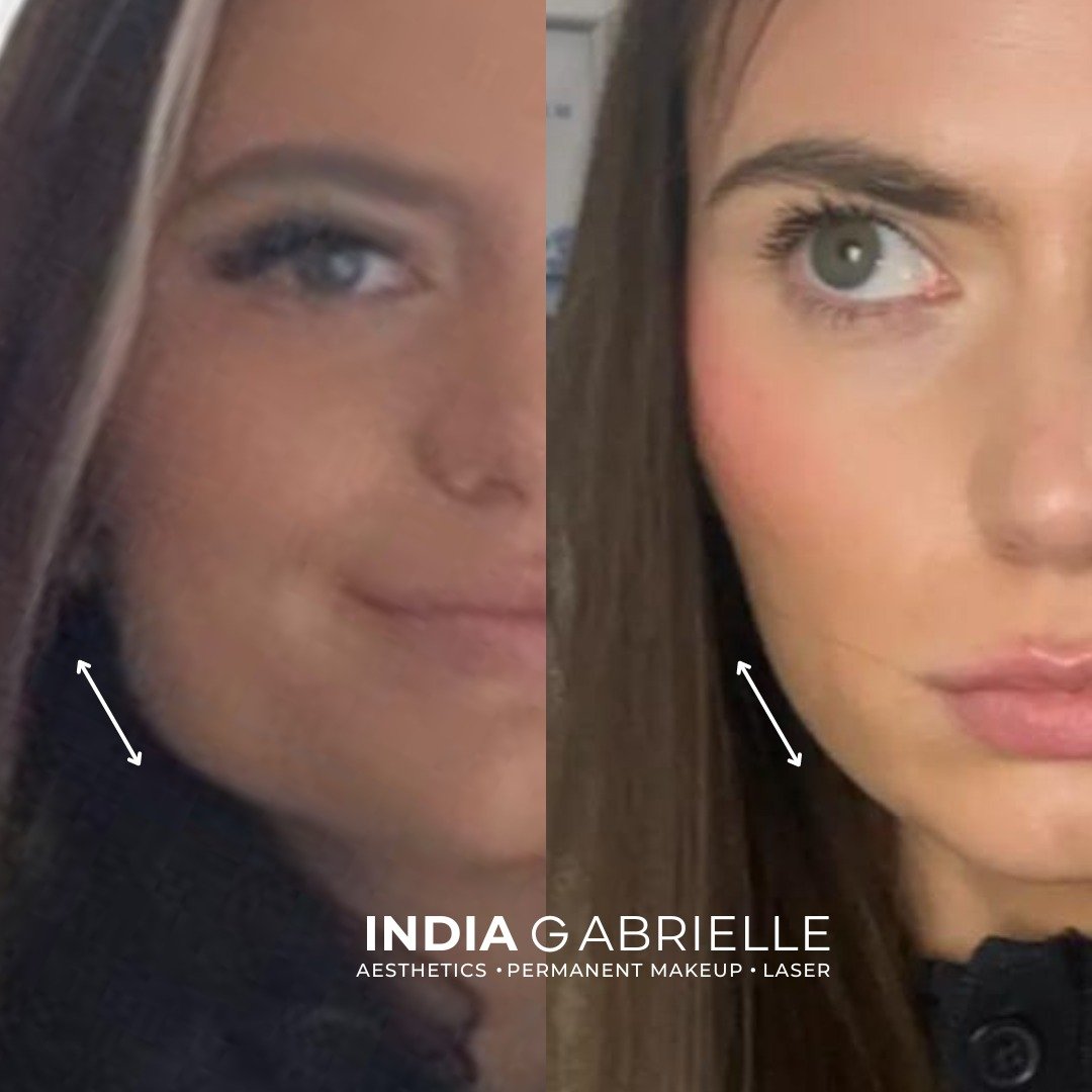 Here is one of my gorgeous clients before and after I did her Masseter Relaxing Injections for Facial Slimming / Jaw Tension 😍
 
She looks absolutely beautiful before and after, but had very strong masseter muscles and she wanted to achieve a slimme