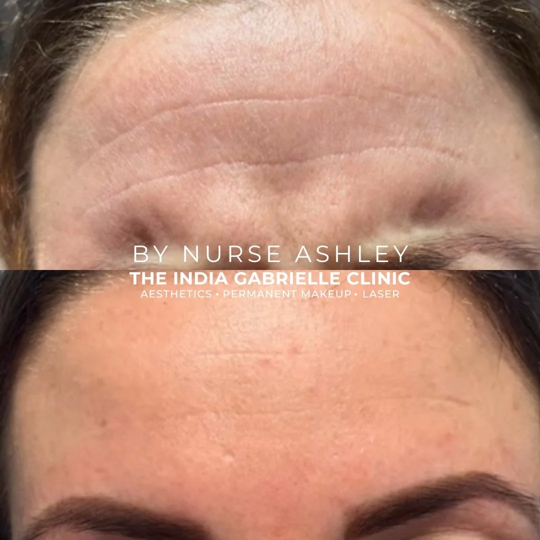 Look at that smooooth forehead - after Wrinkle Relaxing Injections by Ashley - our Level 7 Advanced Aesthetics Nurse Prescriber 💉

This treatment can take 1-2 weeks to work - so make sure you book ahead of any occasions you have coming up 🥰

Unsure