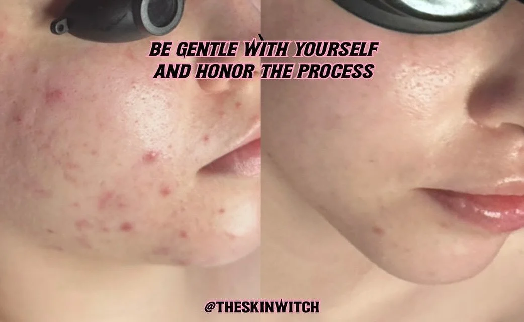 I hate resizing before and afters and it makes me insane lol&hellip; but hey let&rsquo;s focus on the real magic🔮😍✨🌙🪩

A few years between photos, and a consistent angel just keeping up with her skin rituals👼🏻

As I say all the time and I am so