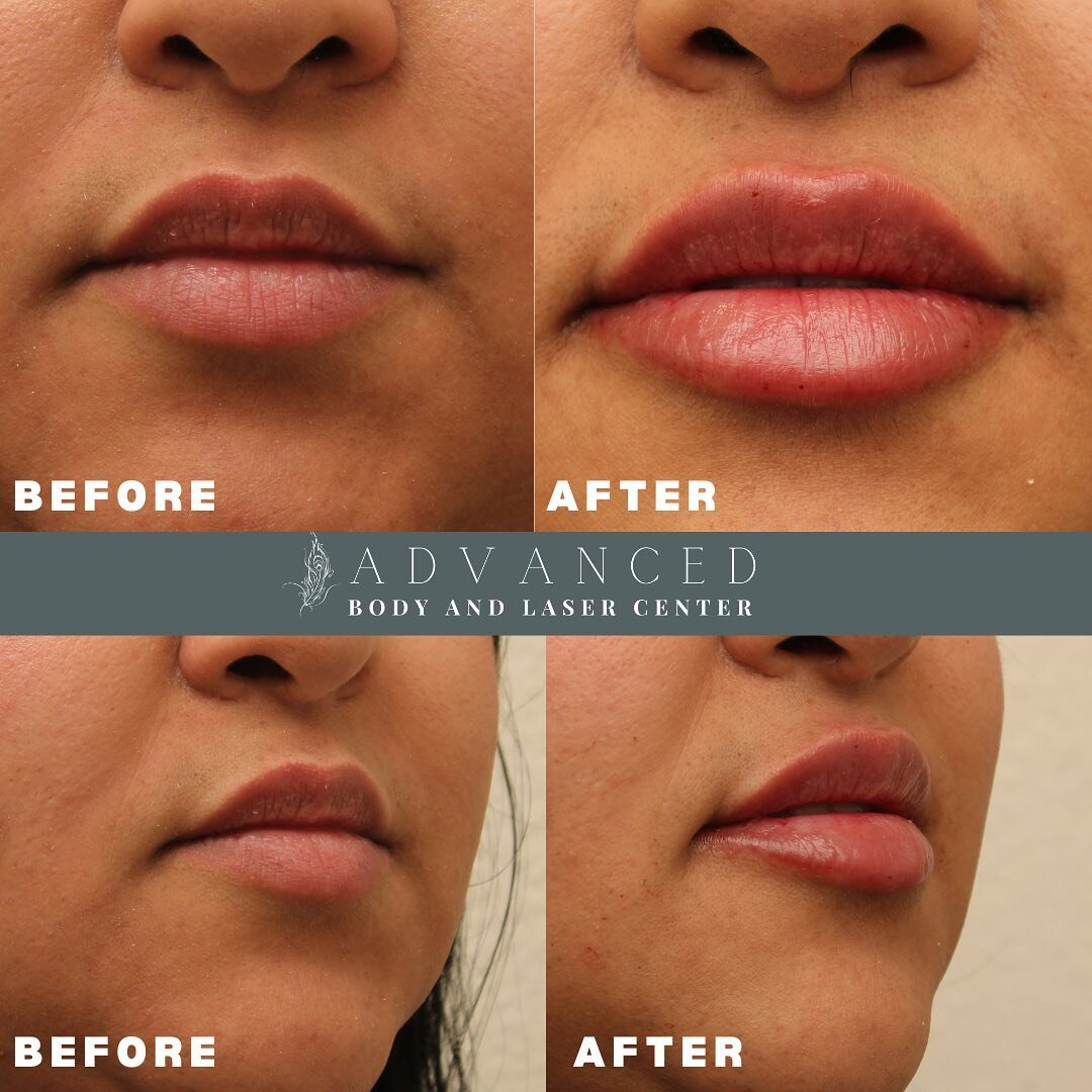 Life isn&rsquo;t perfect, but your lips can be! 💋

Advanced treatment: One syringe of Juvederm Ultra
Advanced Beauty Nurse: Erica R

📍Medical Spa
Call/text (559) 636-0808 Ext. 1
ablcvis@gmail.com 
115 N. Akers St. Visalia, CA 93291 

📍Day Spa
Call