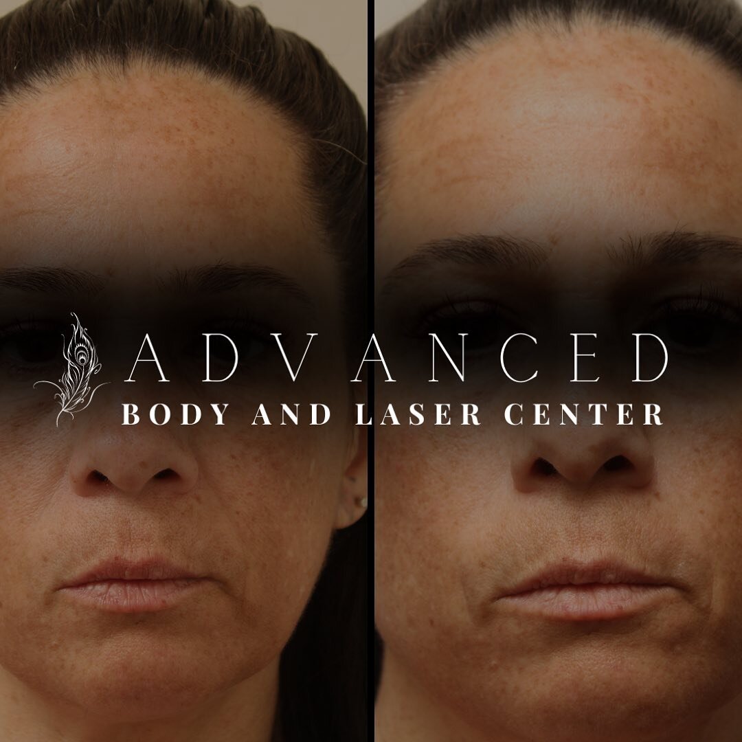 Targeting the foundation to your structure is key to Avoid unnecessary treatment and allow you to enhance your natural beauty ✨

👩🏼&zwj;⚕️Advanced Beauty Nurse: Kylie
💉Advanced treatment: Two syringes of Juvederm Voluma in the mid-face. 

📍Medica