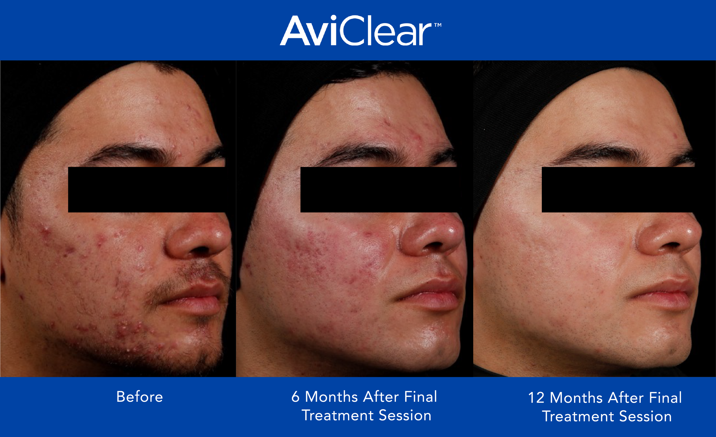 AviClear Before and After _12 month_1.png