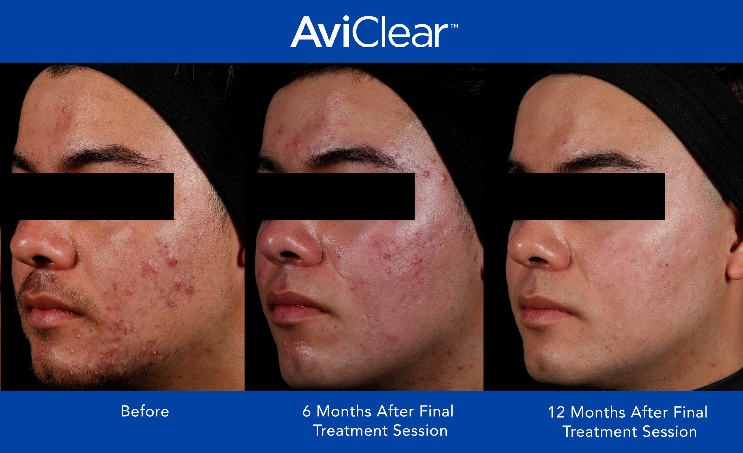 AviClear Before and After Template_12 month_2.png