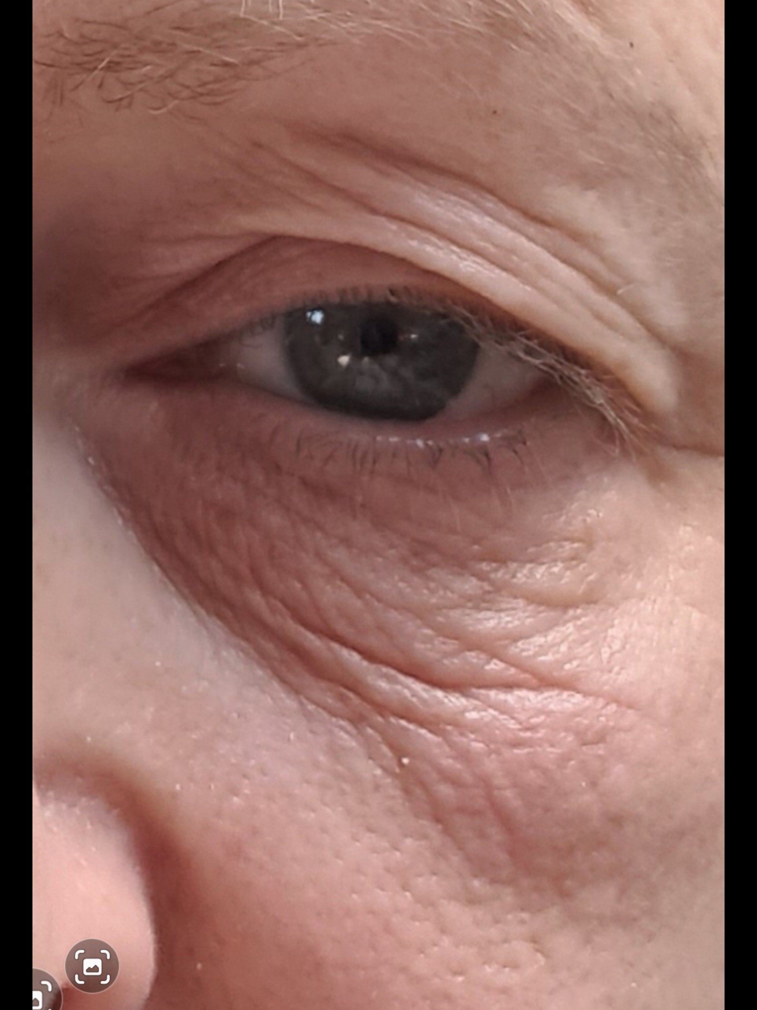 eye set Before Sofwave Treatment.jpg
