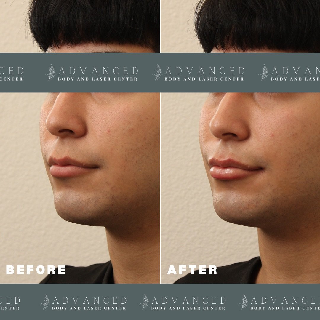 Before &amp; After brought to you by our Advanced Beauty Nurse Practitioner, Adina✨

👄Advanced treatment: Lip filler
💉Product: One syringe of Juvederm Ultra
🥼Advanced Beauty NP: Adina
💰Price: as low as $360
⏰Length of appointment: Approximately 3