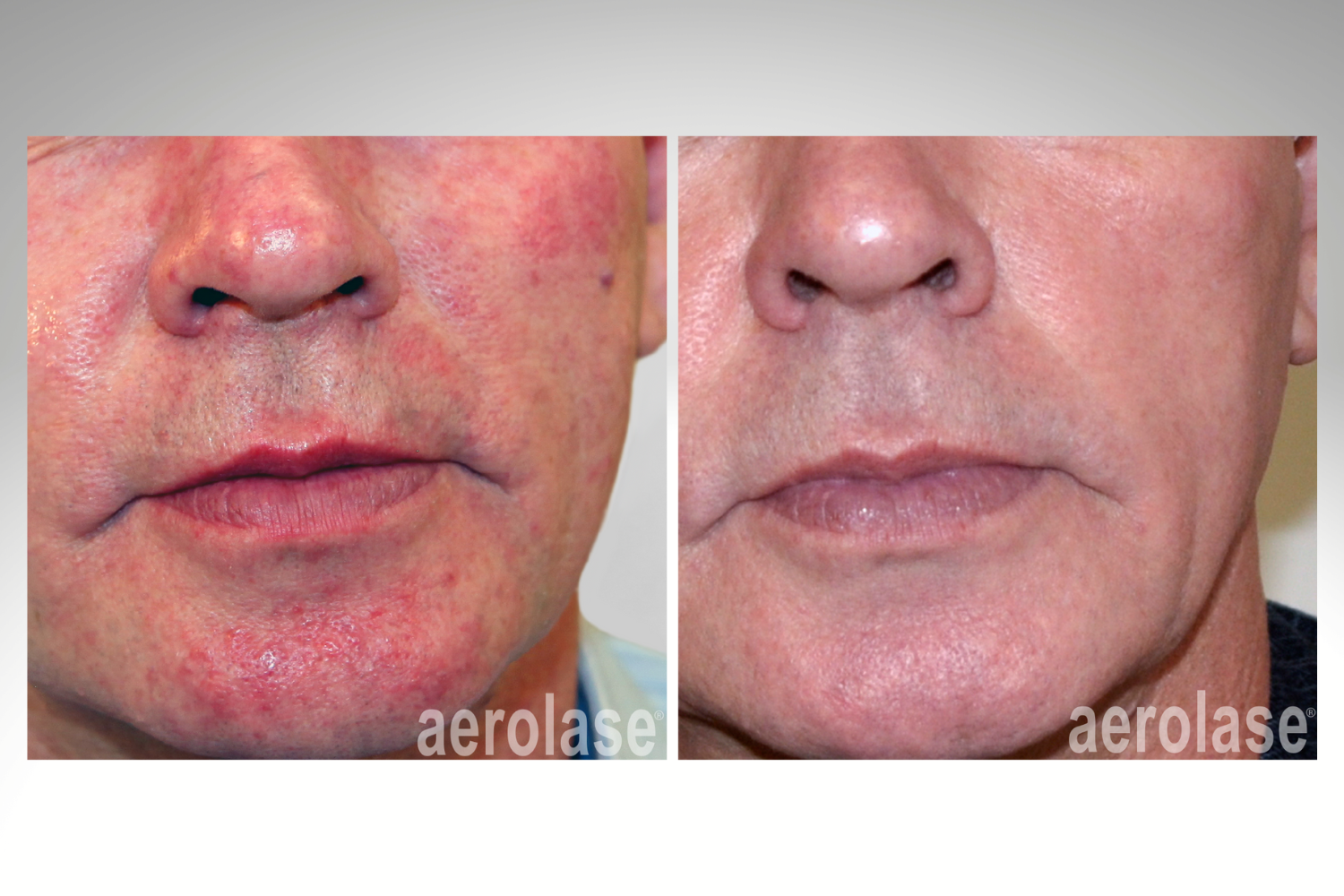 Advanced Laser Facial Treatments — TavieMD MedSpa