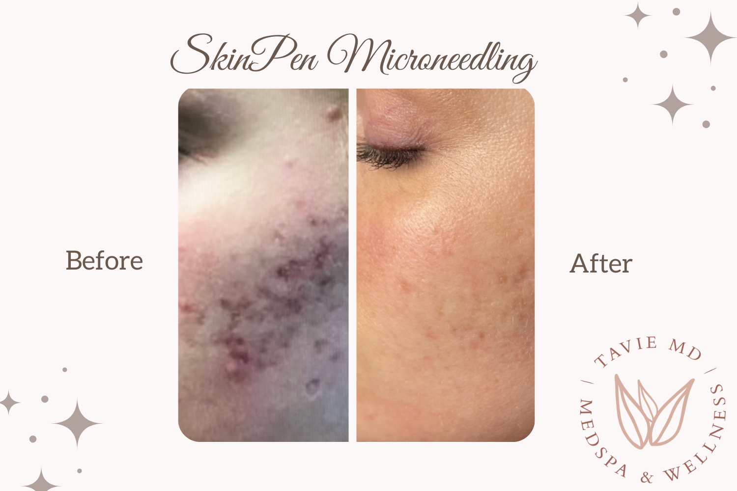 SkinPen Microneedling in Fort Worth — TavieMD MedSpa
