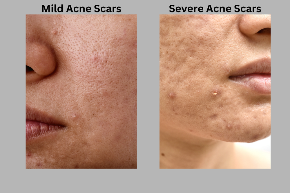 Very Mild Acne Scars