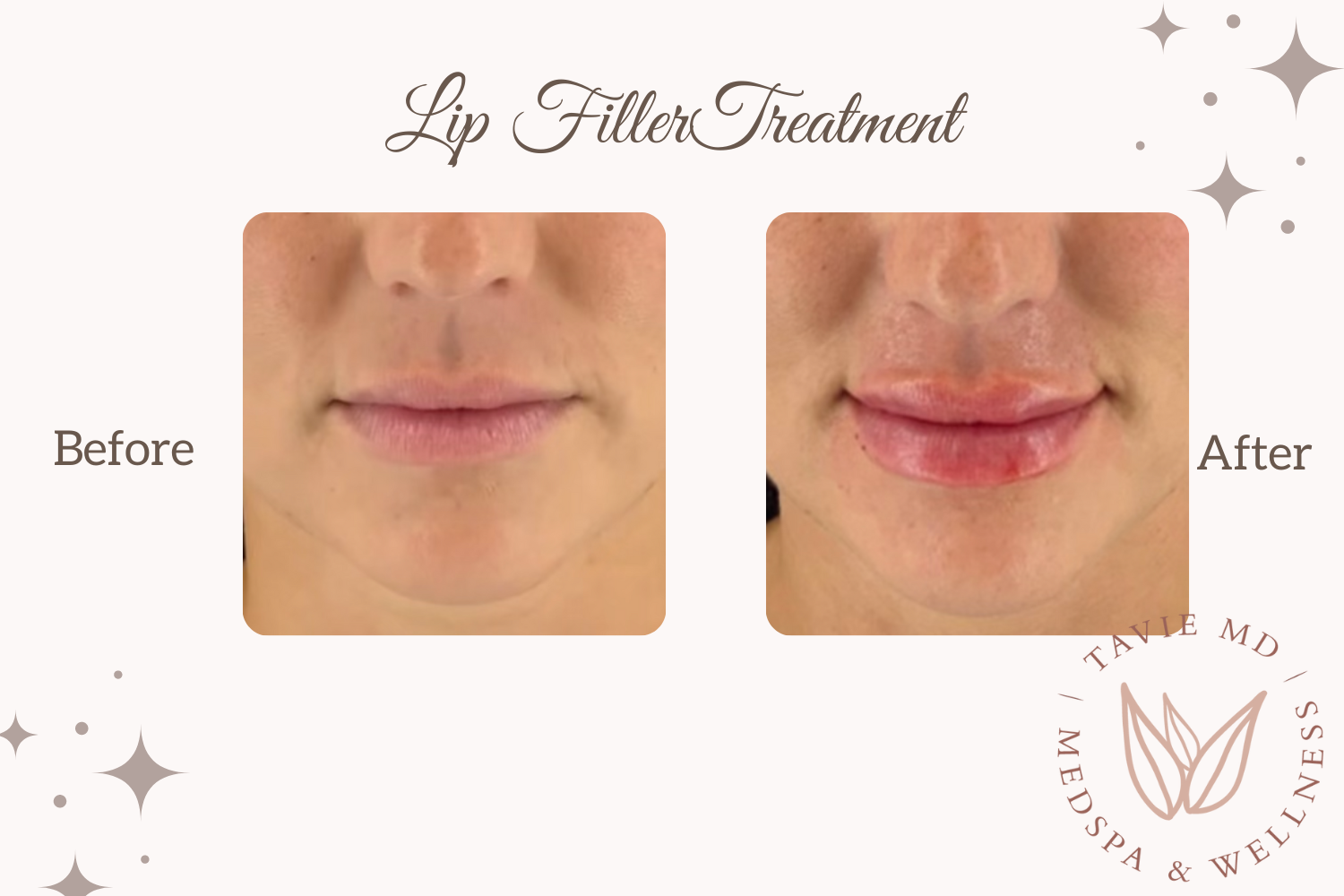 Dermal and Lip Fillers in Fort Worth — TavieMD MedSpa