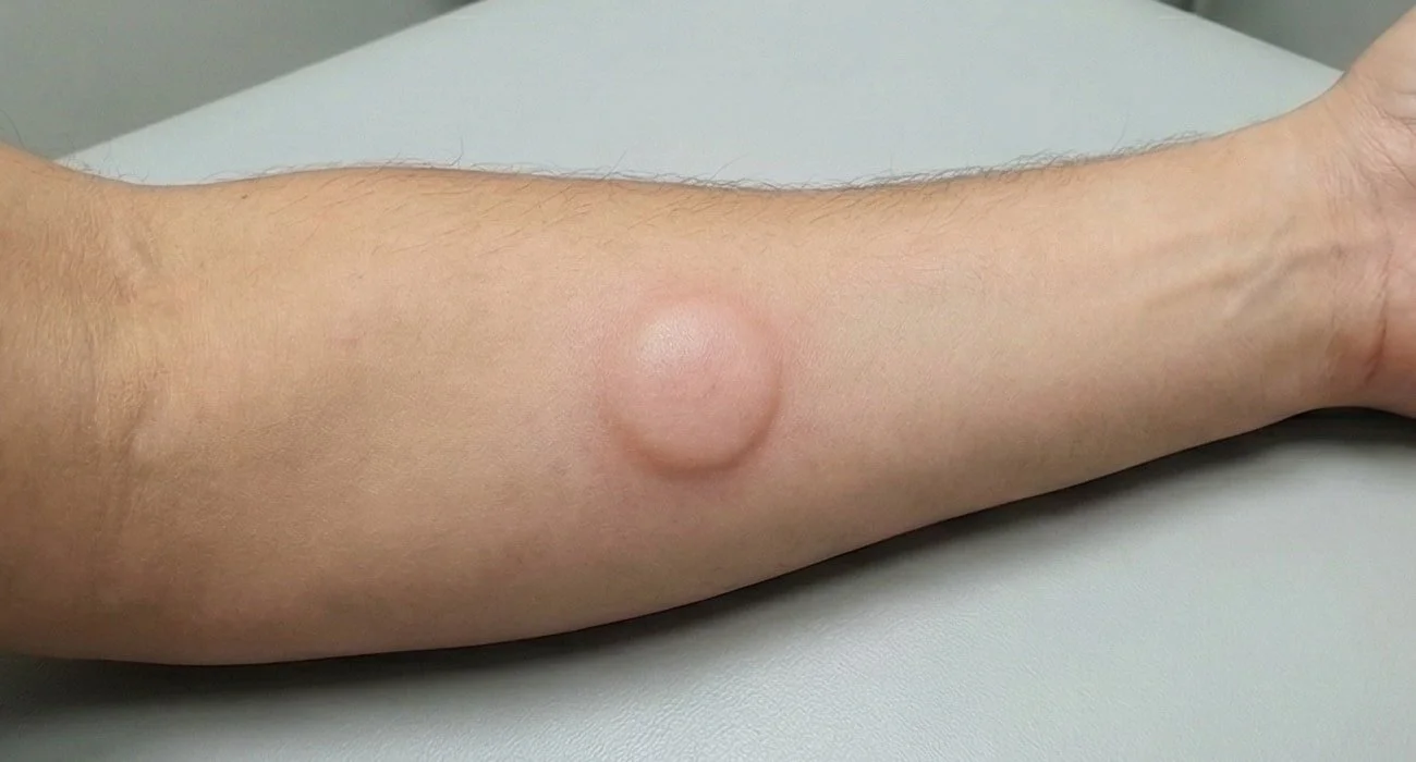 Close-up of a positive PPD tuberculosis skin test showing a raised induration on the forearm