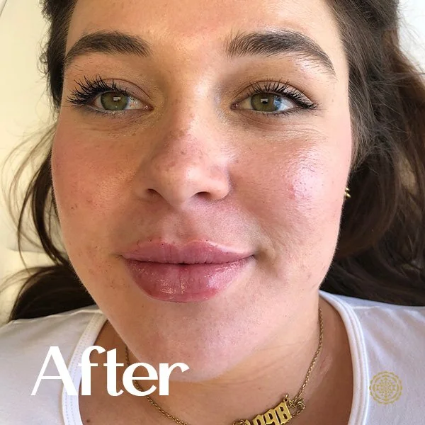 Lip Filler-After