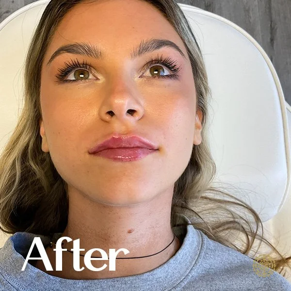 Lip Filler-After