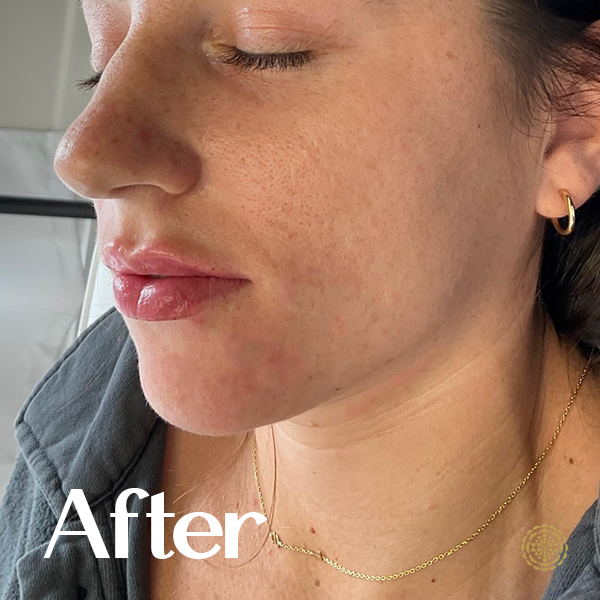 Lip Filler-After