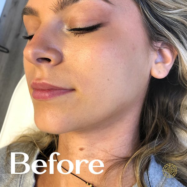 Lip Filler-Before
