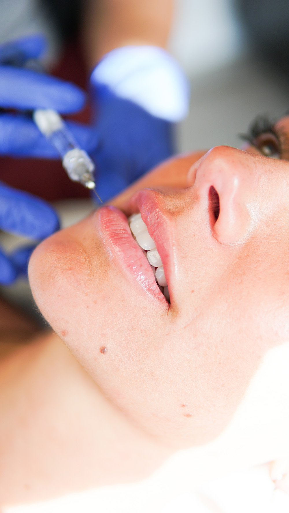 Align Wellness - Lip Filler