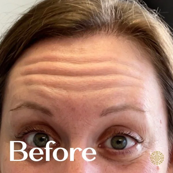 Forehead Botox-Before