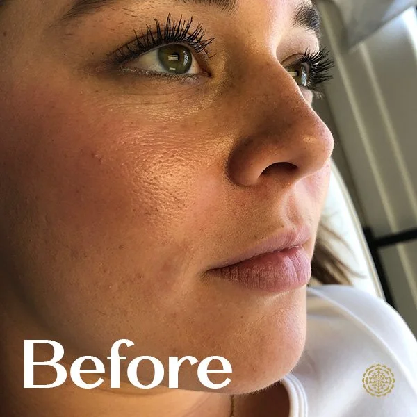Lip Filler-Before