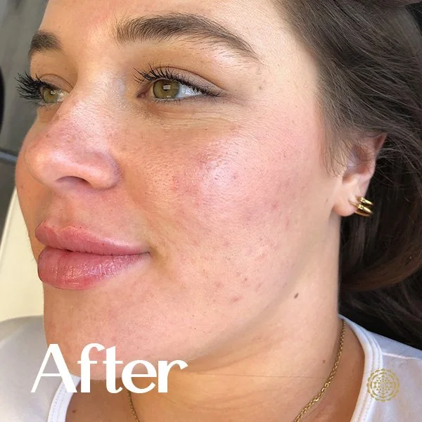 Lip Filler-After