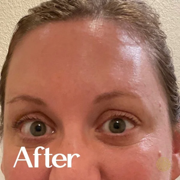 Forehead Botox-Before