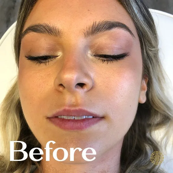 Lip Filler-Before