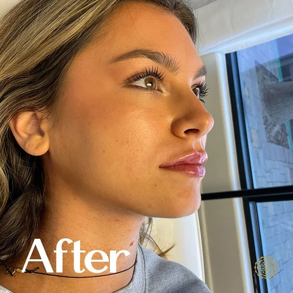 Lip Filler-After