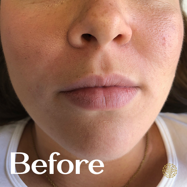 Lip Filler-Before