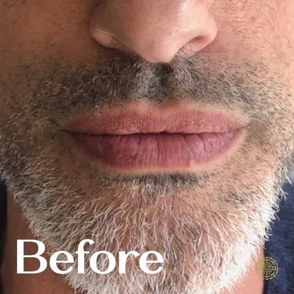 Lip Filler-Before