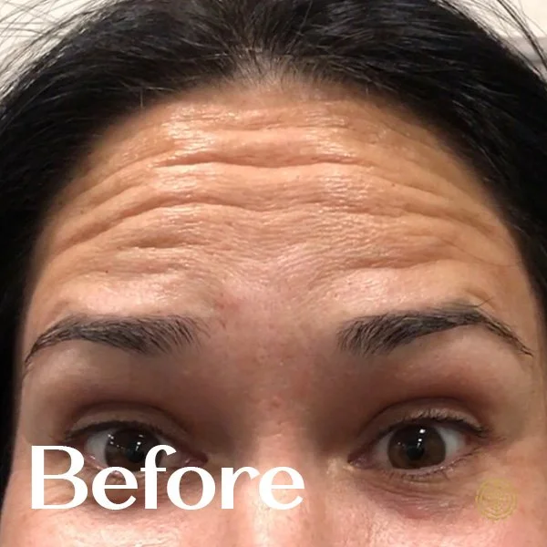 Forehead Botox-Before
