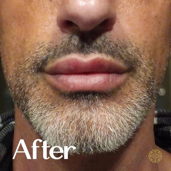 Lip Filler-After