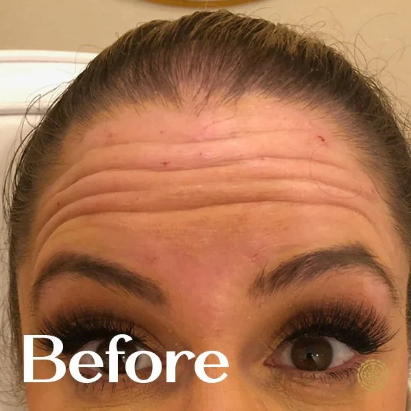 Forehead Botox-Before