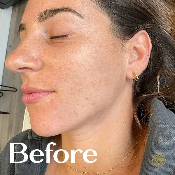 Lip Filler-Before