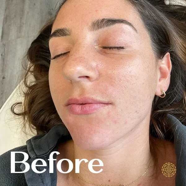 Lip Filler-Before