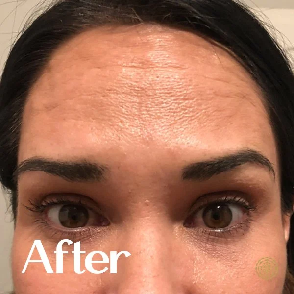 Forehead Botox-Before