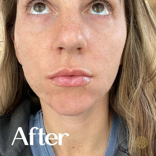 Lip Filler-After