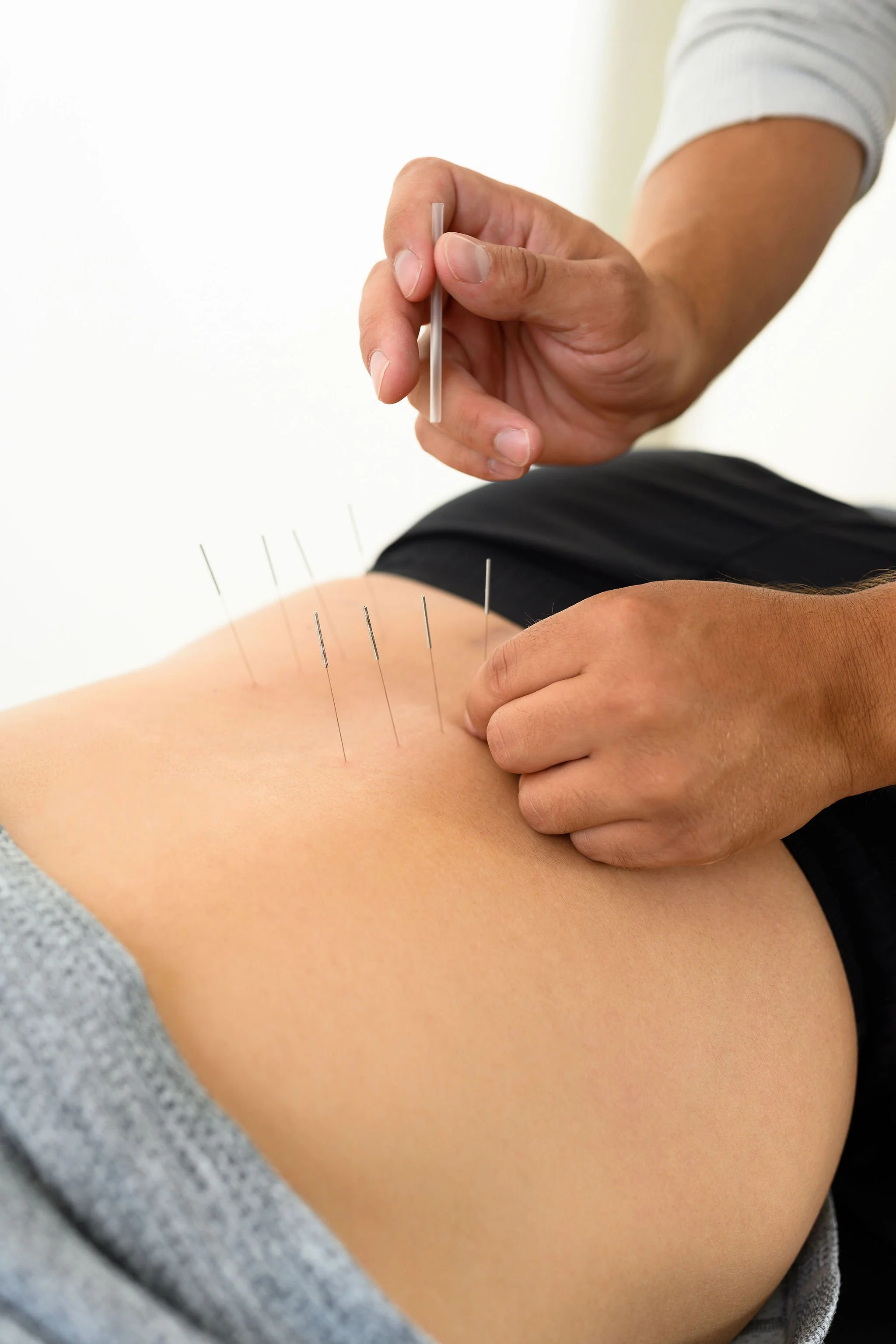 Acupuncture in Toronto, ON