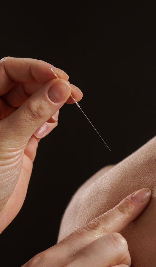 Dry Needling Treatment