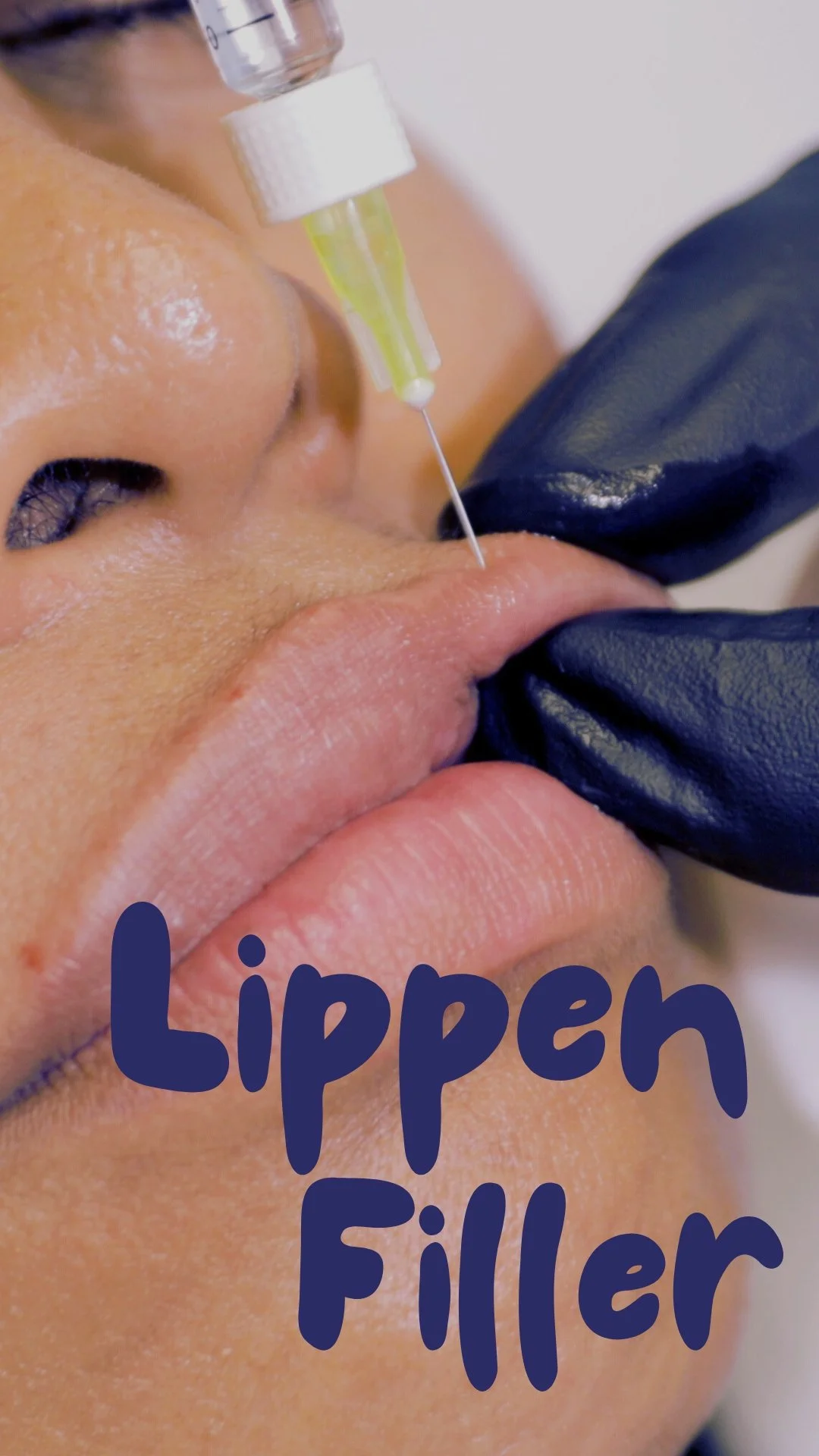 Nahaufnahme einer Person, die eine Lippenfüllung erhält, mit einer Nadel und einer Spritze, die in die Lippen eingeführt wird, während eine Person mit schwarzer Handschuhe assistiert. Text im Bild: 'Lippen Filler'.