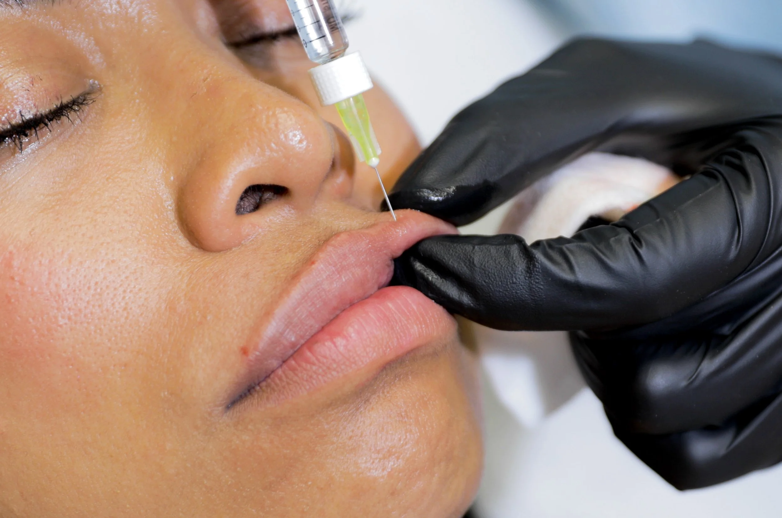 Eine Person erhält eine Nasen- oder Lippenbehandlung mit einer Spritze, während eine andere Person schwarzhandschuh trägt, die sie unterstützt.