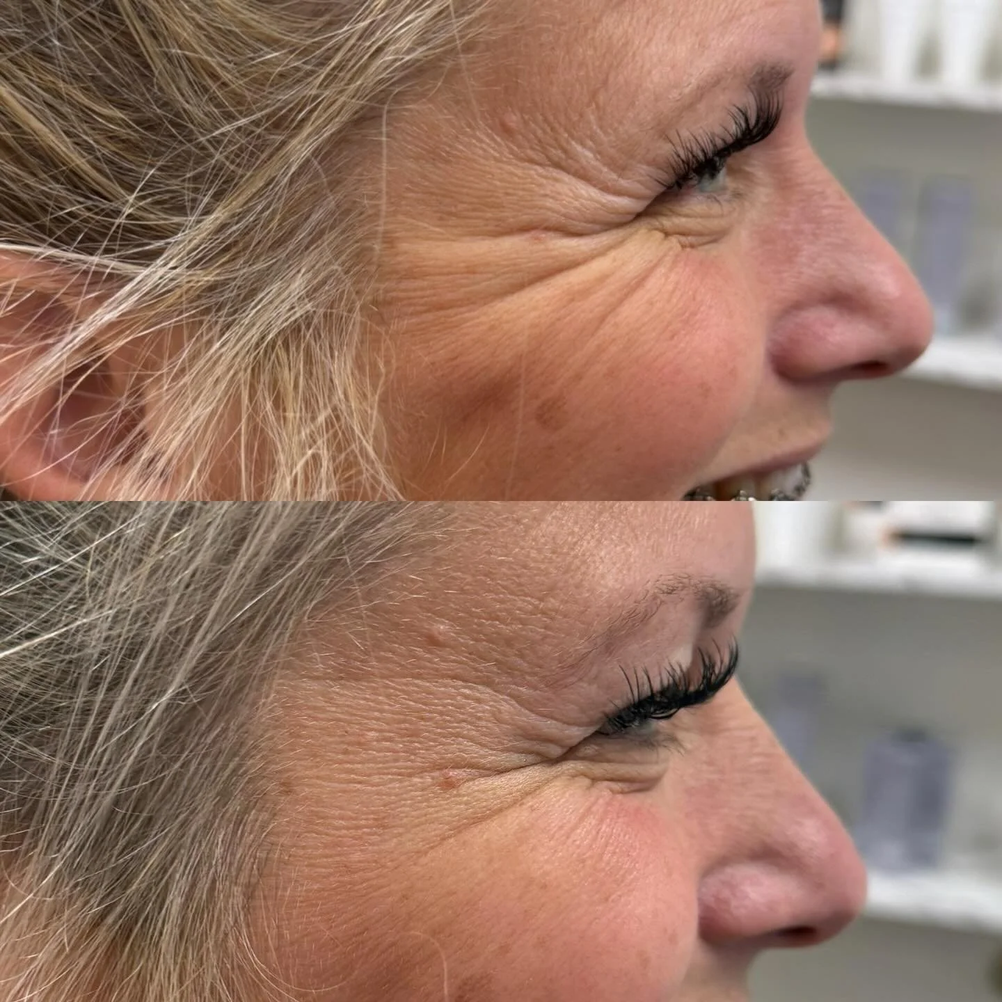 ❣️This gorgeous client came to me after having a really bad Botox experience a few years ago. She was hesitant, nervous and not sure about trying Botox again. 

🎙️We talked through her concerns and goals... I wanted to make sure she felt comfortable