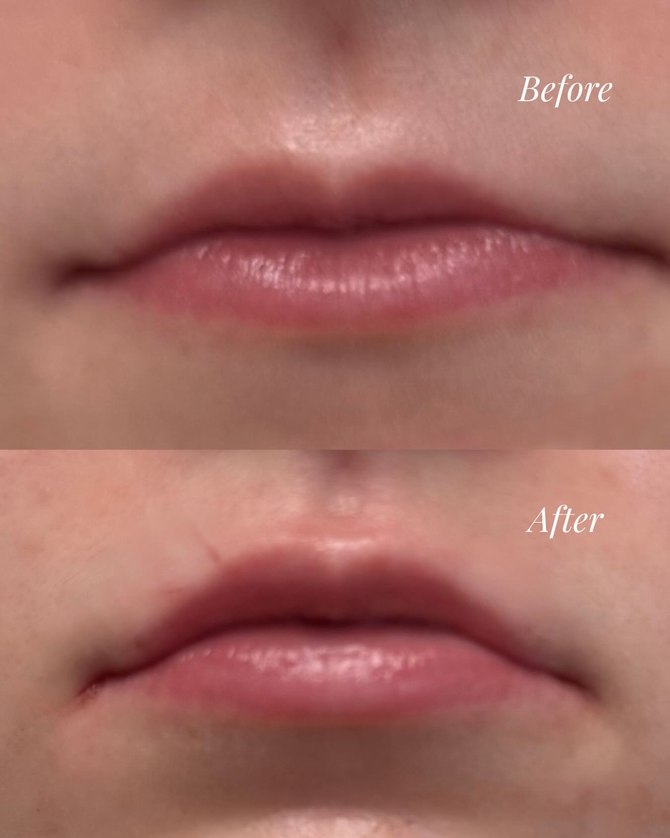 Strategic lip filler isn&rsquo;t just about making lips bigger &ndash; it&rsquo;s about creating harmony, supporting, facial balance, and enhancing what already exist. The result is more volume, better symmetry, and a refreshed look that still feels 