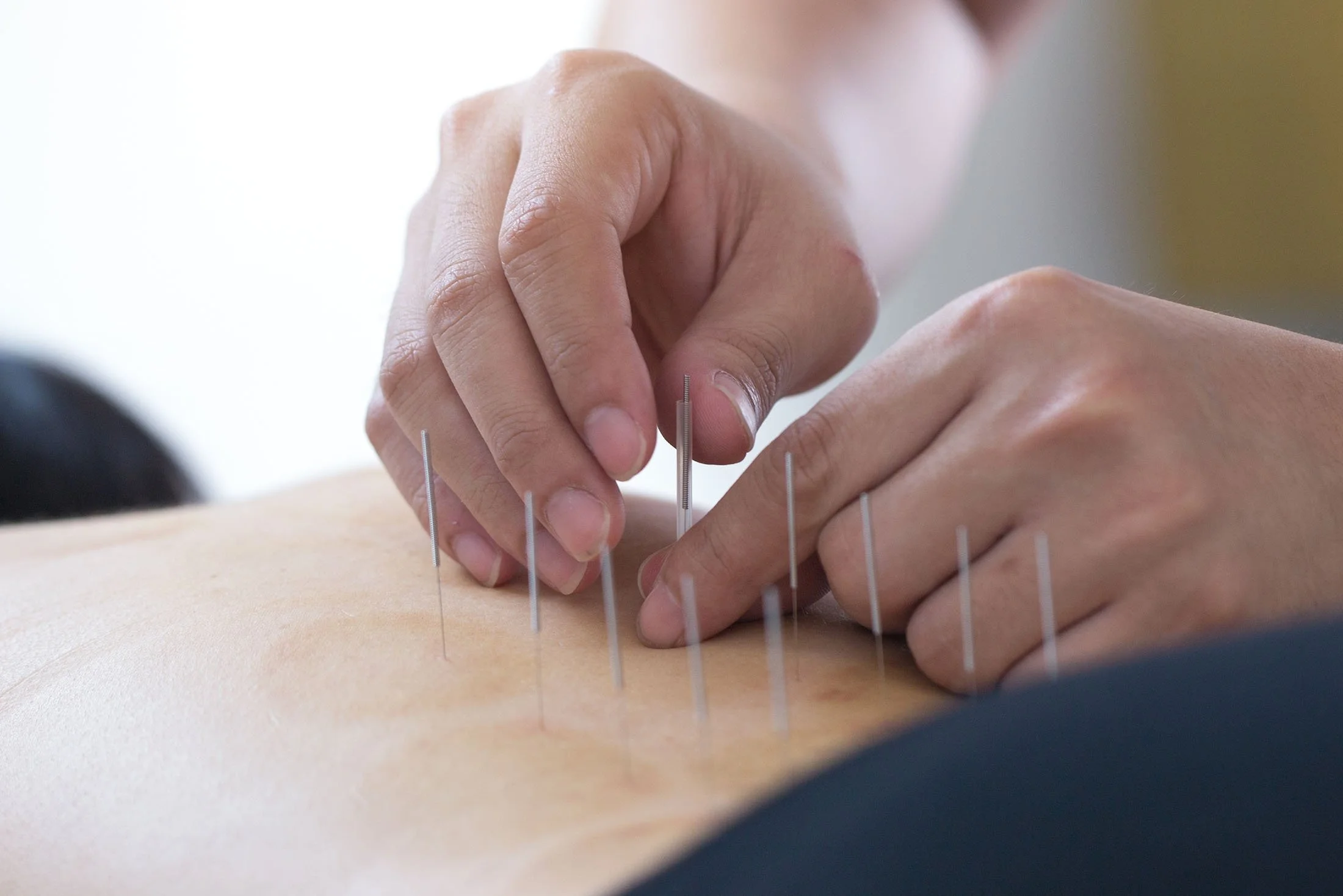 How Acupuncture Can Support Smoking Cessation