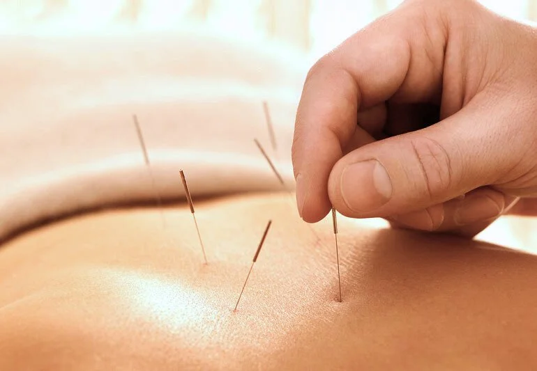 How Does Acupuncture Relieve Sciatica and Nerve Pain Naturally?