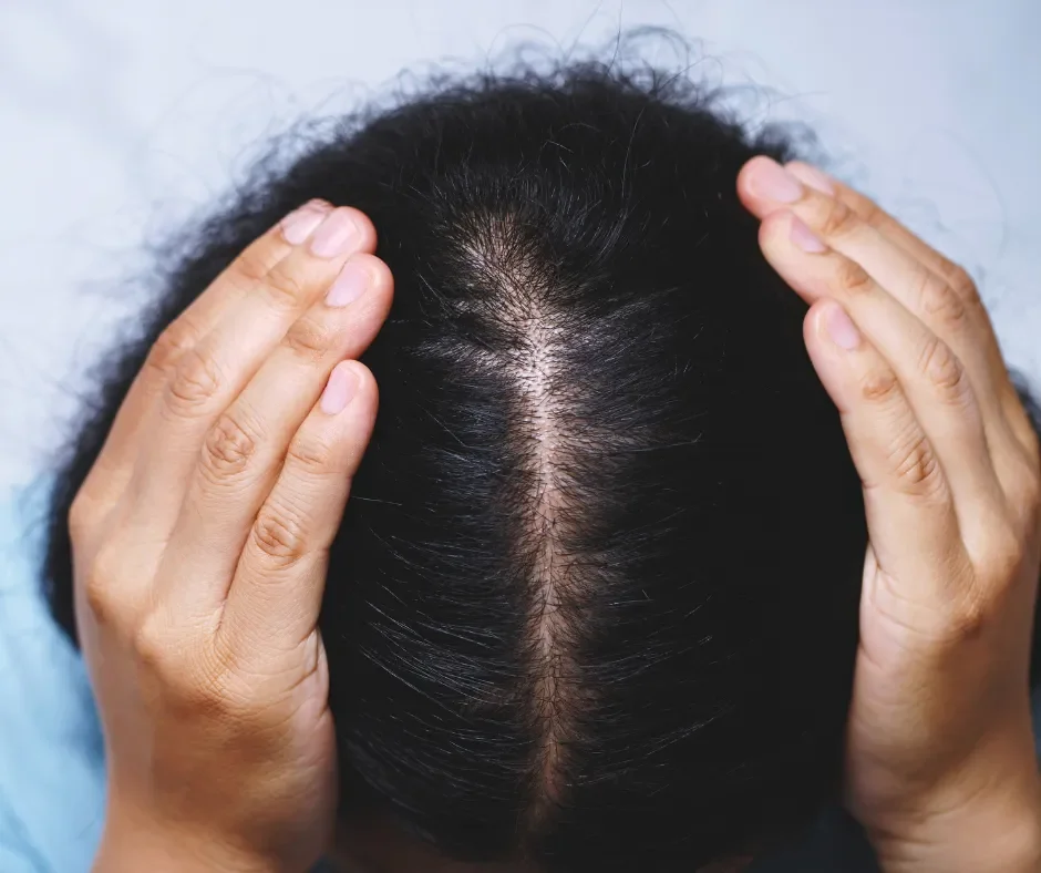Can Acupuncture Help with Hair Loss in Women?
