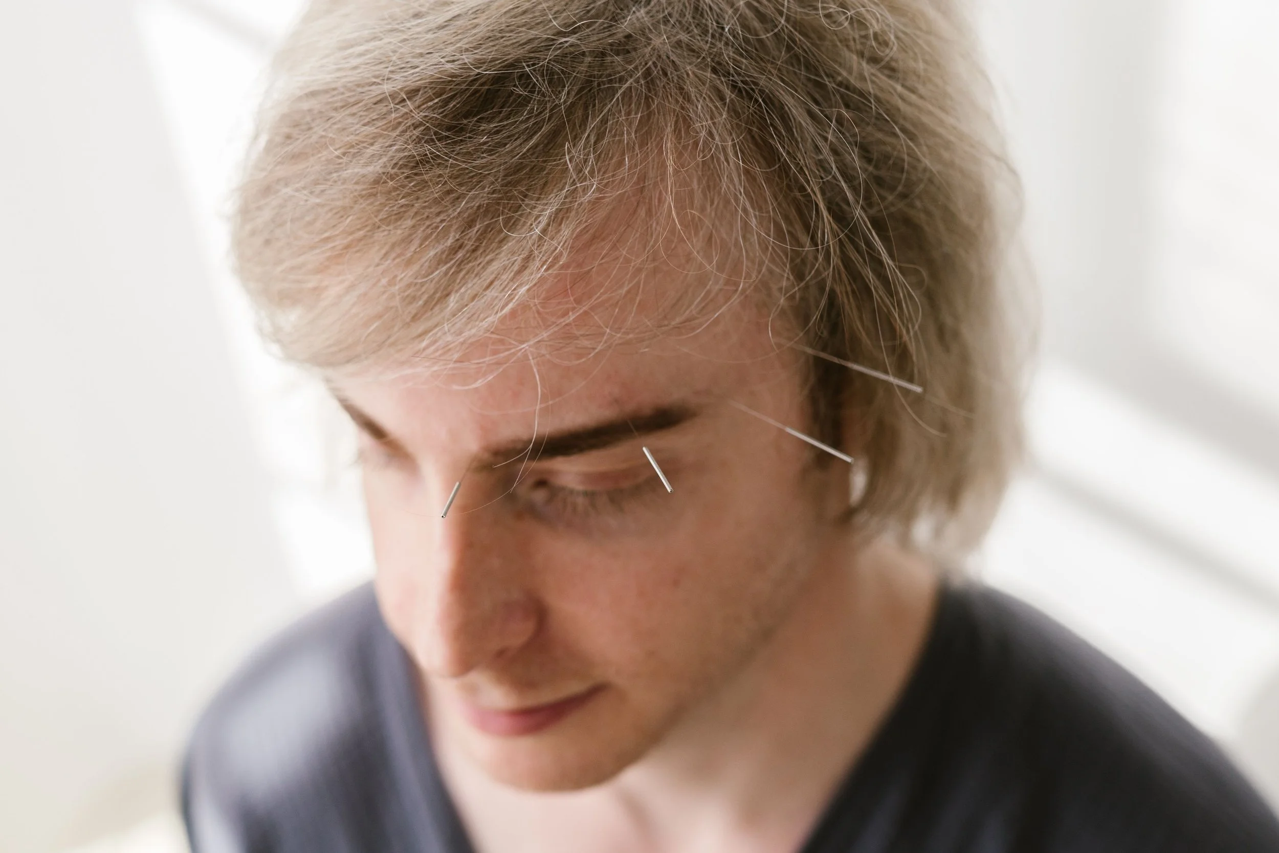 Acupuncture for Insomnia: A Brooklyn Practitioner's Guide to Better Sleep