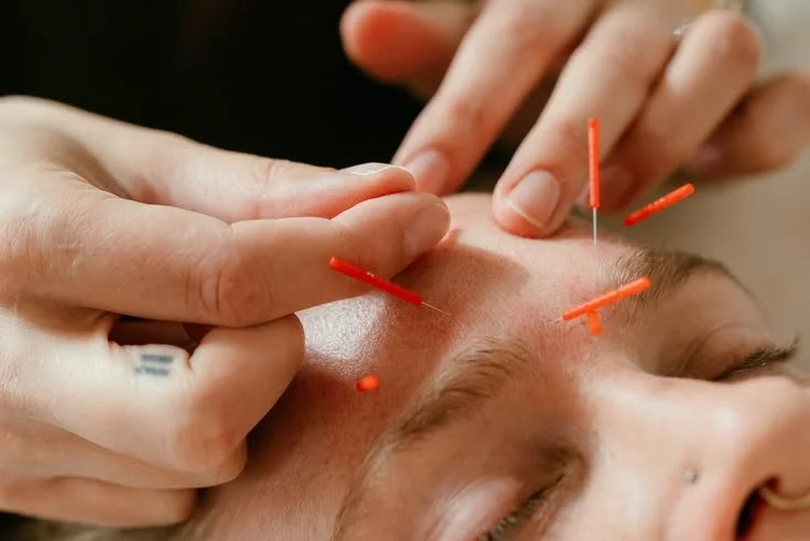 Acupuncture for Depression and Anxiety in Brooklyn: An Integrative Guide