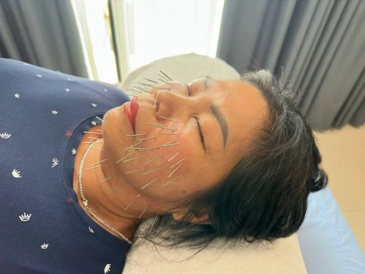 Acupuncture for Rosacea: The TCM View on Heat and Flushing