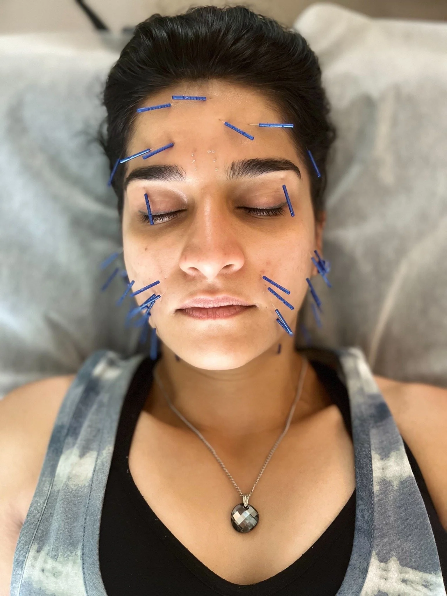 Facial_Acupuncture_1-rotated.jpg